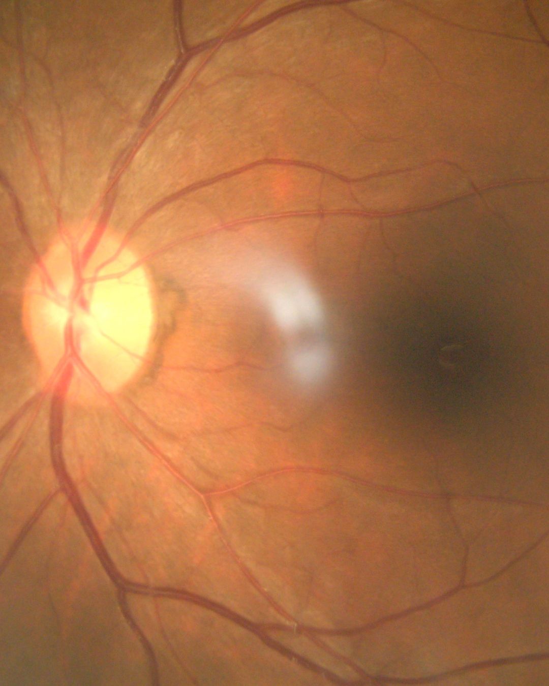 Manejo de retinopatía diabética